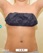 Liposuction