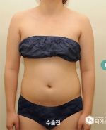 Liposuction