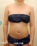 Liposuction