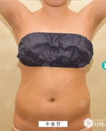 Liposuction