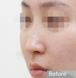 Rhinoplasty