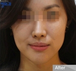 facial contouring