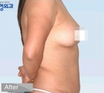 Liposuction