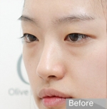 Rhinoplasty