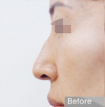 Rhinoplasty