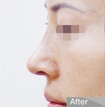 Rhinoplasty