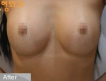 breast