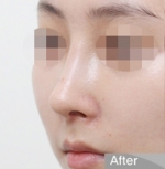 Rhinoplasty