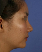 Rhinoplasty