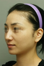 Rhinoplasty