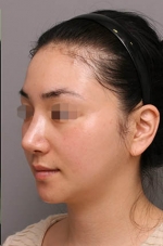 Rhinoplasty