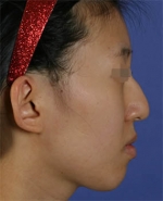 Rhinoplasty