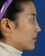 Rhinoplasty