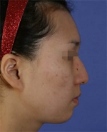 Rhinoplasty