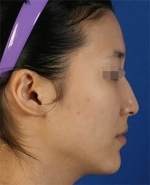 Rhinoplasty