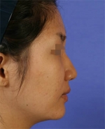 Rhinoplasty