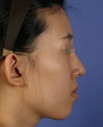 Rhinoplasty