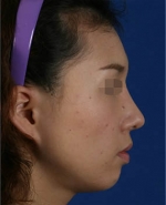 Rhinoplasty