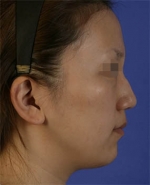 Rhinoplasty