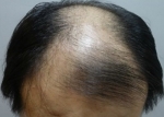 hairline