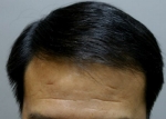 hairline