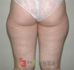 Liposuction