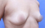 breast