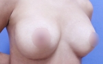 breast