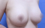 breast