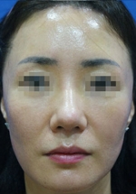 Rhinoplasty