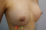 breast