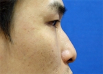 Rhinoplasty