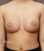 breast