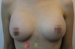 breast