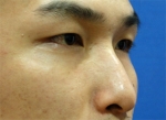 Rhinoplasty