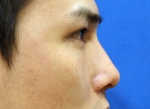 Rhinoplasty