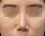 Rhinoplasty