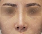 Rhinoplasty