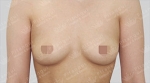 breast