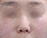 Rhinoplasty