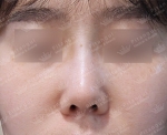 Rhinoplasty