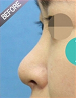 Rhinoplasty