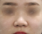 Rhinoplasty