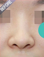 Rhinoplasty