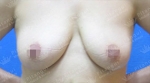 breast