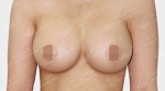 breast