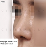 Rhinoplasty