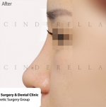 Rhinoplasty