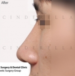 Rhinoplasty