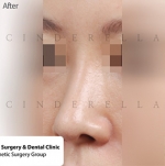 Rhinoplasty